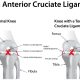 Anatomy Of The Anterior Cruciate Ligament (ACL) Injury